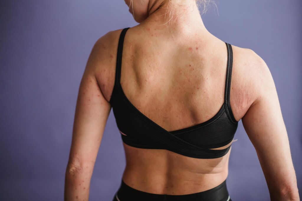 Tinea Cruris (Jock Itch) in Indian Gym Environments: Risk Factors, Recurrence, and the Role of pH-Controlled Skin Hygiene in Prevention